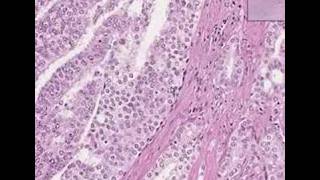 Histopathology ProstateAdenocarcinoma Gleason grade 4 [upl. by Assiren]