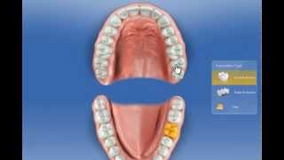 Sirona CEREC SW 40 Phase Administration [upl. by Grae162]