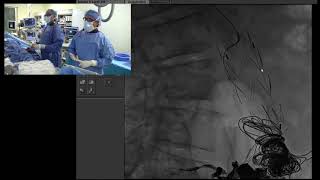 Transradial Endoleak Angiography post EVAR for Aortic Aneurysm [upl. by Naves]