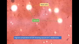 Cryptococcus capsules in Nigrosin preparation [upl. by Naasar308]