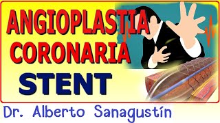 CATETERISMO CARDÍACO y ANGIOPLASTIA CON STENT ¡Lo que necesitas saber [upl. by Humfrid]