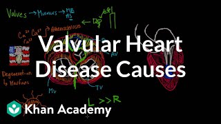 Valvular heart disease causes  Circulatory System and Disease  NCLEXRN  Khan Academy [upl. by Knowlton]