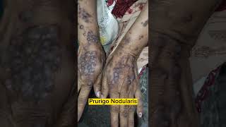 Prurigo Nodularis  Dermacase  Chronic Itching 😳 dermatology skincare pruritus pigmentation [upl. by Alejna]