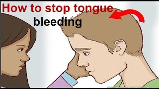 How to stop tongue bleedingHow to stop tongue from bleeding in easy and simple steps [upl. by Ayatnwahs112]