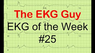 EKGECG of the Week 25  The EKG Guy  wwwekgmd [upl. by Heeley513]