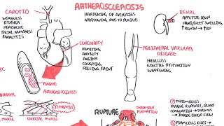 Atherosclerosis  Pathophysiology [upl. by Weil]