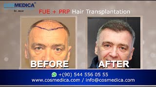 COSMEDICA DRACAR 3000 Grafts FUE Hair TransplantTurkeyIstanbul [upl. by Kemp9]