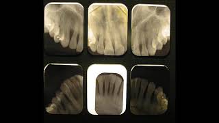 Periodontitis no calculus 30 yo patient [upl. by Leuqram932]