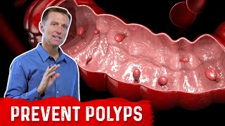 What is a Polyp – The Best Food for Colon Polyp Prevention – Dr Berg [upl. by Asia]