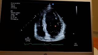 Infarto anteroseptal Infarto agudo al miocardio Ecocardiograma Phillips CX50 [upl. by Noellyn]