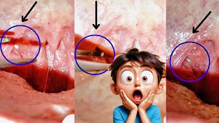 Tonsil Stone Removal Procedure Irritable but Difficult to remove why it Fails [upl. by Rolan]