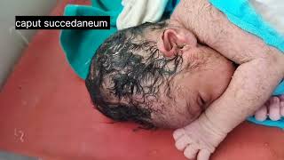 caput succedaneum  swelling of the scalp in newborn [upl. by Justicz]