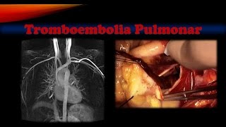 Tromboembolia pulmonar [upl. by Orsola]