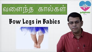 வளைந்த கால்கள்  Bow legs in babies  தமிழ் [upl. by Lemal608]