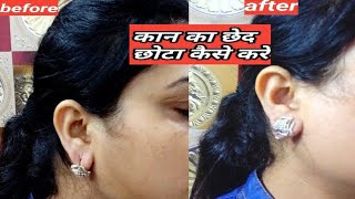 कान के छेद को छोटा करने के उपाय कान के छेद को छोटा कैसे करेंhow to repair earlobeskaan ka ched [upl. by Ahsytal]