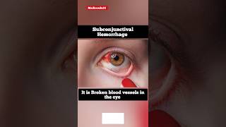 Subconjunctival Hemorrhage shorts pictures [upl. by Jany]