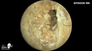 196  Swimming induced Otitis Externa Outer Ear Infection Removal with WAXscope®️ [upl. by Casper]