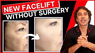 NEW PROCEDURE Facelift WITHOUT Surgery 🔥 Ellacor Micro Coring [upl. by Ellenij229]