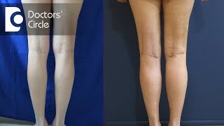 Surgical correction of bow legs  Dr Surindher D S A [upl. by Lashondra430]