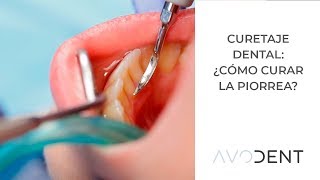 Curetaje dental ¿cómo se cura la piorrea  Clínica dental en Alcobendas  Avodent [upl. by Nednarb730]