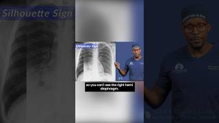 Chest Xray Silhouette sign Let’s learn what this means pulmonary science medicalimaging [upl. by Raynata]