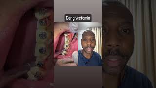 Gengivectomia dentes gengiva dentista [upl. by Joed]