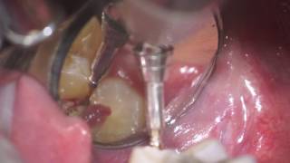 operculectomy of mx 3dr molar [upl. by Zirkle468]