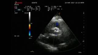 Arotic Stenosis Dr S K Parashar [upl. by Hance489]