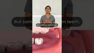 Ask the Dentist Does everyone have wisdom teeth 🤔🦷 wisdomteeth askthedentist [upl. by Aniat763]