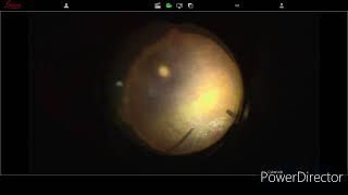 Luxated IOL rescue with sutureless scleral fixation IOL [upl. by Nwadal]