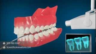 Medical Animation explaining Dental Radiography  Dental XRays [upl. by Sher]