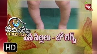 Jeevanarekha child care  Bow Legs  9th November 2016  జీవనరేఖ చైల్డ్ [upl. by Valtin]