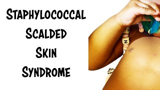 Staphylococcal Scalded Skin Syndrome [upl. by Yrred]