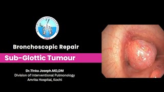 Subglottic Airway Tumour  Bronchoscopic management [upl. by Ylrebmyk]