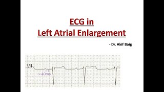 ECG in Left Atrial Enlargement  Dr Akif Baig [upl. by Maretz162]