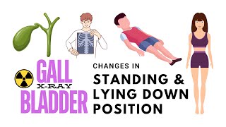 Gallbladder X Ray changes in standing and lying down position gallbladderstones xray [upl. by Eadwina]