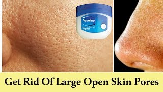 How to Get Rid of Large Open Pores Permanently  Large Open Pores on Face Treatment Naturally [upl. by Enilrad122]