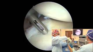 Arthroscopic Posterior Labral Repair  Randy S Schwartzberg MD [upl. by Aiehtela]