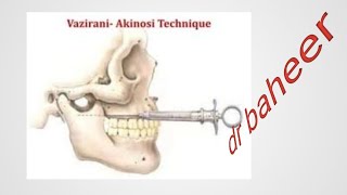 Akinosi technique  closed mouth injection [upl. by Korfonta360]