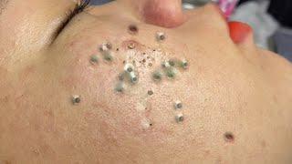 Blackheads amp Acne Treatment 21052024 Part 1 blackhead whitehead acne blackheadremoval [upl. by Essined381]