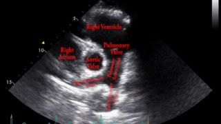 Echocardiogram Parasternal Short Axis View Pulmonary Arteries  Loop [upl. by Valeta]