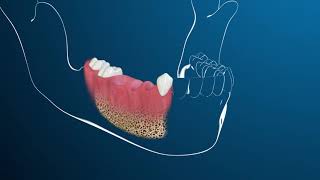 Les implants dentaires cest quoi [upl. by Bronnie]