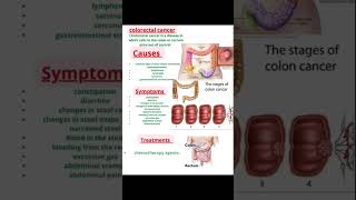 Colorectal cancer colon cancer Rectum cancer [upl. by Baun]