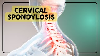 Cervical Spondylosis [upl. by Cnut29]