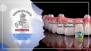 Odontología para todos Prótesis dental total superior con implantes [upl. by Rolan]