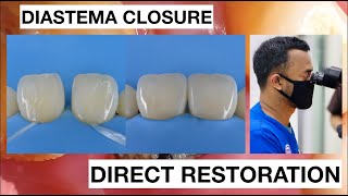 Diastema Closure with Direct Bonding Composite Restoration  General Dentist Griya RR [upl. by Ahsekin132]