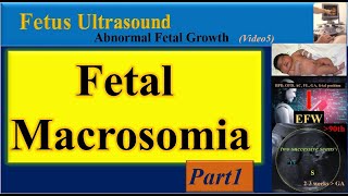 Fetus Ultrasound Fetal Macrosomia Part1 [upl. by Alleyn]