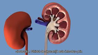 JJ Stent removal of kidney stones 3 [upl. by Diandra]