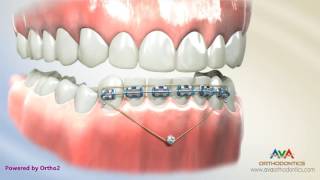 Orthodontic Treatment for Deepbite  Temporary Anchorage Device or TAD [upl. by Mizuki]