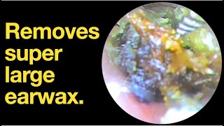 Removes super large earwax ear wax removal  ear cleaning  ASMR  relaxation  relax [upl. by Arias]